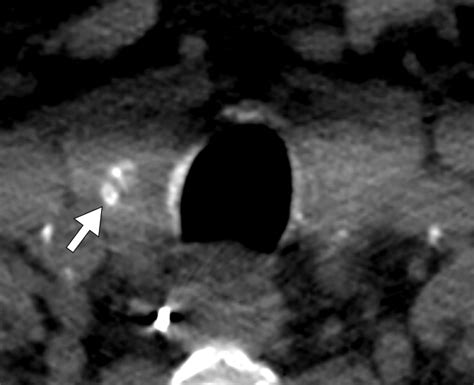 Three Tiered System For Incidental Thyroid Nodules Do Not Forget The