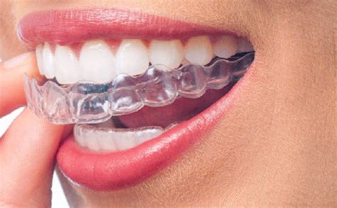 Invisible Braces For Teeth Straightening Teeth Braces