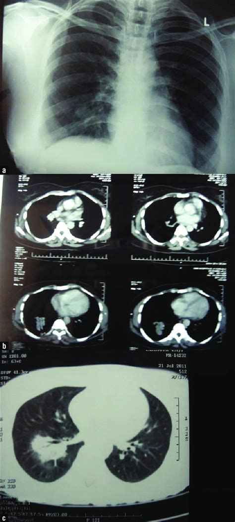 A B C Chest X Ray And Ct Thorax Depict A Lobulated Mass In Superior