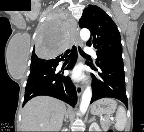 Neurogenic Sarcoma Right Chest And Chest Wall Chest Case Studies
