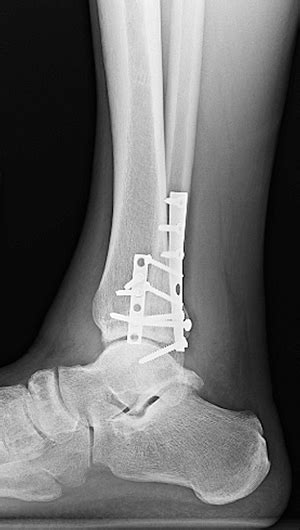 Broken Ankle Compound Fracture Foto Kolekcija