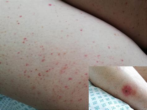 Two Case Reports Of Skin Vasculitis Following The Covid 19 Immunization