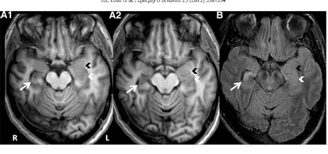 Amygdala Mri Sagittal