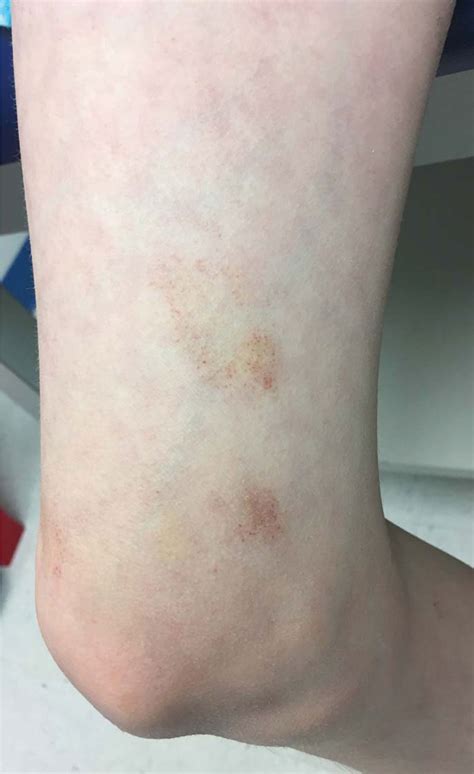 A 9 Year Old Girl With Petechial Patches On Her Legs