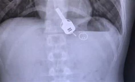 Drunk Man Swallowed His Keys And Needed Surgery To Get Them Out