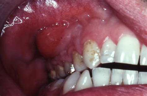 Abscess Tooth Dental Abscess Causes Signs Symptoms Diagnosis