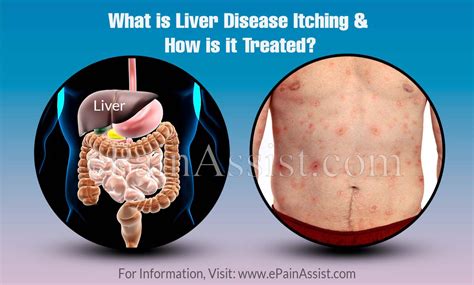 What Is Liver Disease Itching And How Is It Treated