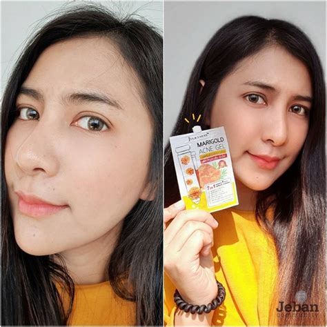 Jula herb, jula's herb, julas herb, จุฬาเฮิร์บ, เซรั่มลำไย, เซรั่มลำไยจุฬาเฮิร์บ, ลำไยจุฬาเฮิร์บ สิวหายจริงด้วยเจลดาวเรืองจุฬาเฮิร์บ