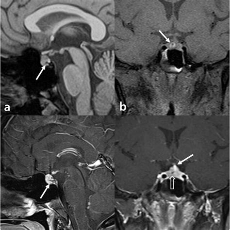 A And B Axial And Sagittal Contrast Enhanced Computed Tomography