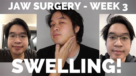 Double Jaw Surgery 3 Weeks Post Op Swelling Update Youtube