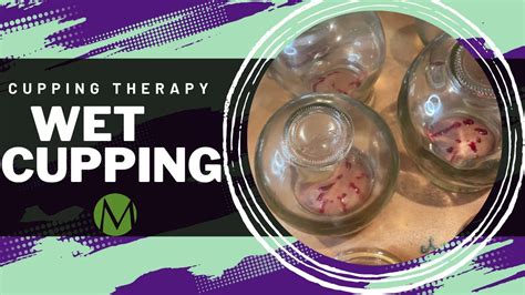 Fire Cupping Therapy Wet Cupping Hijama Youtube