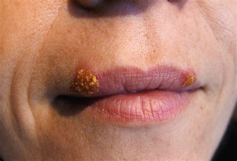 Mar 19, 2018 · the best approach to treating a cold sore is to attack it early before it can even be seen. 8 Foods You Should Avoid to Prevent Cold Sores | Just ...