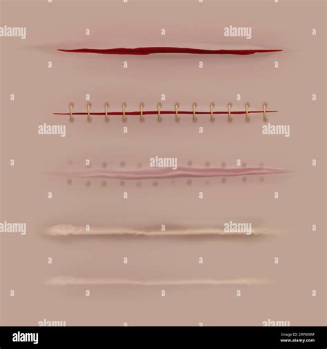 Surgical Sutures Healing Stages Realistic Bloody Wound And Stitch
