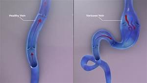 The Science behind Spider Veins - Scientific Animations  Heart and Circulation Varicose Veins