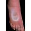 A Swollen Foot In Case Of Pitting Oedema Photograph By Science Photo 