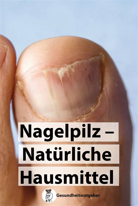 Natürliche Hausmittel Von Researcher1 Auf Health Hausmittel Nagelpilz