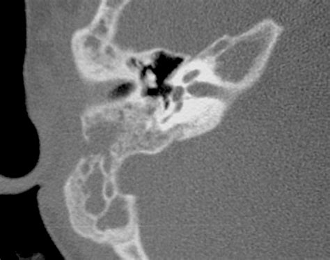 Imaging Of Complications Of Acute Mastoiditis In Children Radiographics