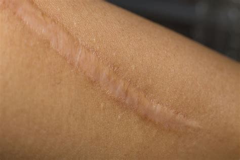 Scar Treatment And Dermatology Traumacare