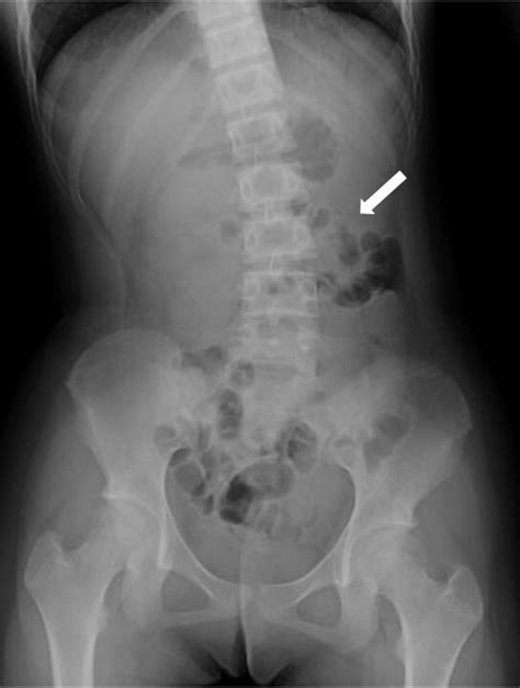Colocolic Intussusception Secondary To Pneumatosis Cystoides