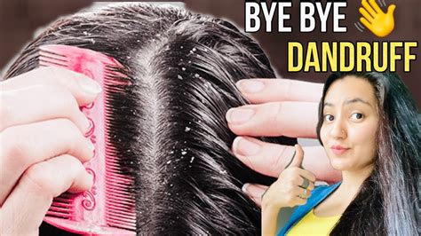 How To Cure Dandruff Naturally At Home Remove In Just 1 Wash