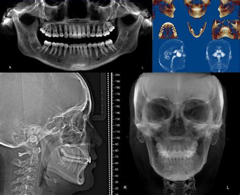 Dento Metric Radiología Oral Y Maxilofacial