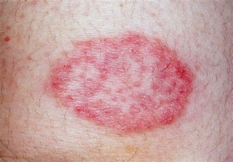 How To Get Rid Of Ringworm Scars Ringworm Of The Scalp Tinea Capitis