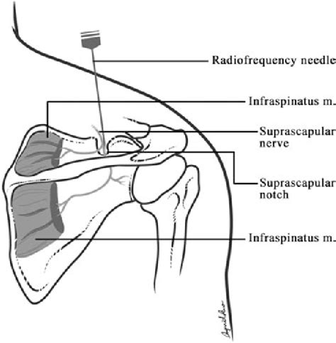 Suprascapular Nerve Pulsed Radiofrequency For Chronic Shoulder Pain In