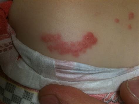 Pediatric Patient With A Rash The Western Journal Of Emergency Medicine