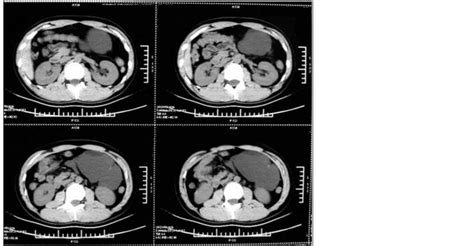 Gossypiboma Presenting As An Atypical Intra Abdominal Cyst A Case Report