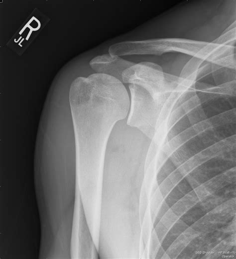 Uw Shoulder And Elbow Academy X Rays For Shoulder Arthritis