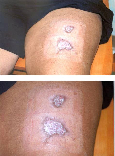 Figure From Third Degree Burn From A Grounding Pad During Arthroscopy