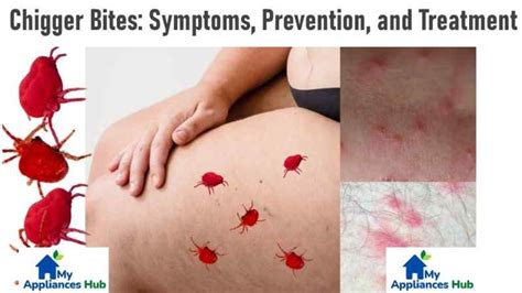 Chiggers Symptoms Prevention Treatment And Control Of Chigger Bites