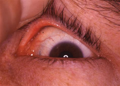 Primary Amyloidosis Of The Eyelid A Case Report In Vivo