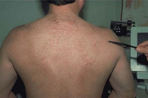 Periarticular Ganglion Cysts Of The Shoulder Musculoskeletal Key