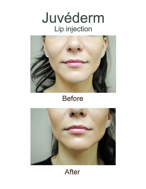 Vollure Lip Filler Before And After Before And After