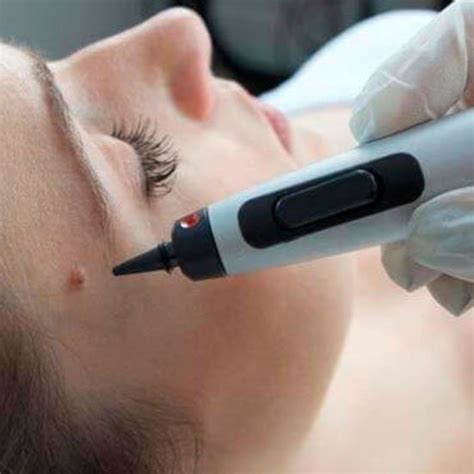 Cryopen Treatments Skin Secrets Beauty Clinic Pudsey Leeds