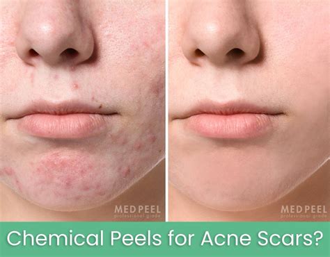 Best Chemical Peels For Acne Scars Medpeel