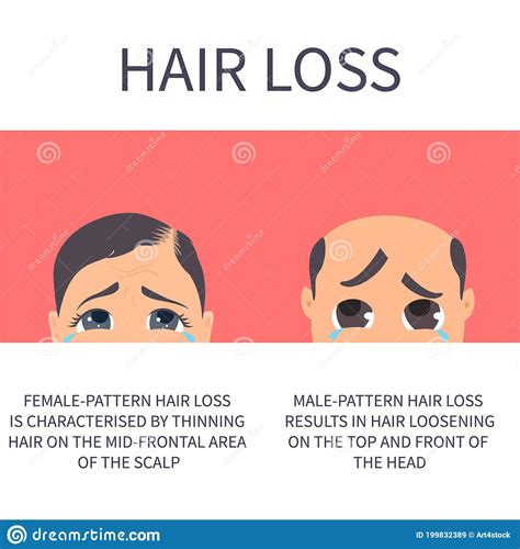 Male And Female Pattern Hair Loss Characteristics Stock Illustration Illustration Of Follicle