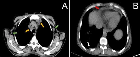 Ct Scan Of The Thorax Showed Multiple Axillary Figure 1a Green