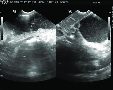 Dilated Fluid Filled Stomach Identified On Ultrasound Download