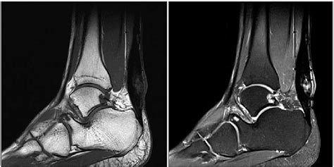Contrast Enhanced T1 And T2 Weighted Sagittal Ankle Magnetic Resonance