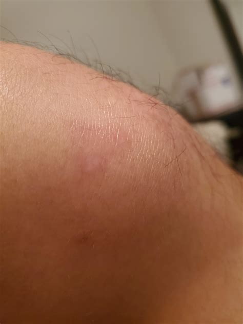 Strange Random Itchy Spots Appearing On Body Diagnoseme