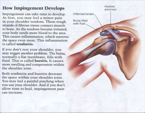 Shoulder pain is a very common problem but it's not usually a sign of arthritis or underlying medical condition. SUBACROMIAL SHOULDER IMPINGEMENT SYNDROME