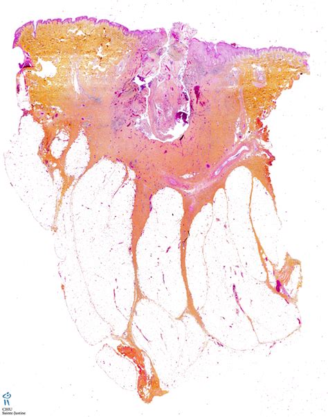 A dermoid sinus, also known as a pilonidal sinus, is a tubular skin defect caused by incomplete separation of the skin and the nervous system during embryonic development. pilonidal sinus - Humpath.com - Human pathology