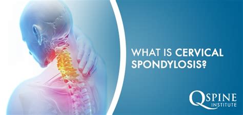 What Is Cervical Spondylosis Q Spine Institute Nj