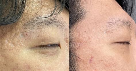 Fraxel Acne Scars Before And After