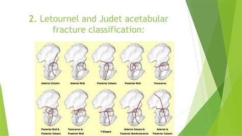 Fracture Classification Ppt