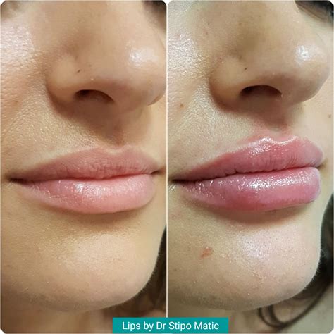 Lip Fillers Maticlinic Aesthetics ǀ Anti Wrinkle Injections ǀ Dermal Fillers