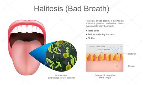 halitosis bad breath education info graphic vector design — stock vector © pattarawit