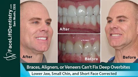 How To Fix An Overbite Naturally At Home Reverasite